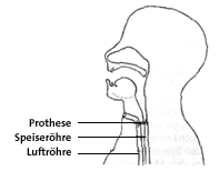 Schema des Sprechens mit Stimmprothese